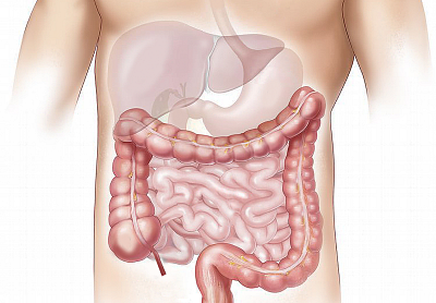 Přednáška o prevenci rakoviny tlustého střeva